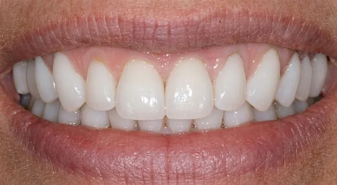 After: the same patient's teeth after veneers.
