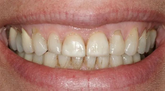 Before: the patient's front teeth before veneers.