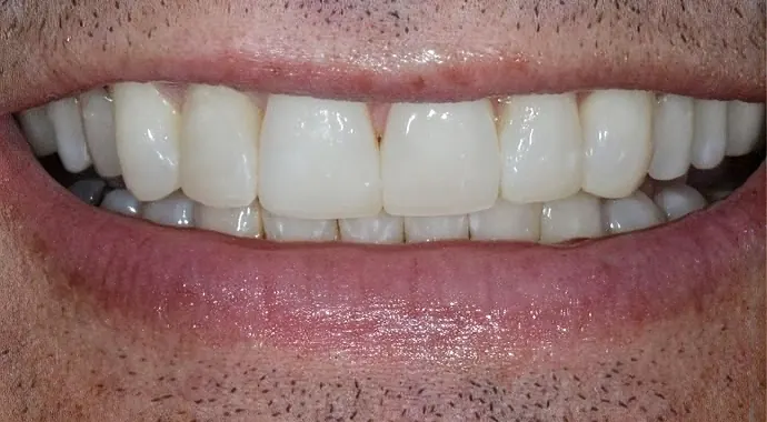 After: the same patient's teeth after dental bonding.
