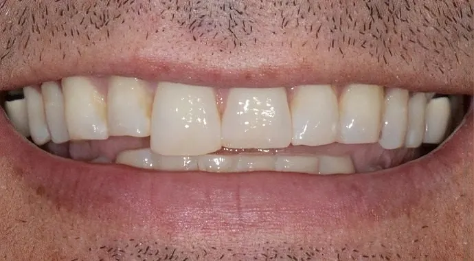 Before: the patient's front teeth before dental bonding.
