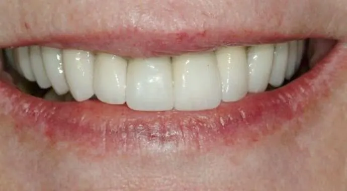 After: the same patient's smile after full mouth reconstruction.