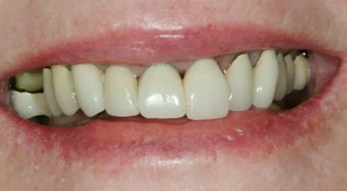 Before: restorations that did not look uniform.